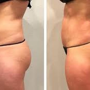 Diamond Cryo - Body Contouring Near Me - Winter Park, Florida Diamond Cryo - Body Contouring Near Me - Winter Park, Florida