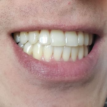 Christopher H Nguyen, DMD, MSD - 3 months after finishing - Orthodontists Near Me - Santa Ana, California Christopher H Nguyen, DMD, MSD - 3 months after finishing - Orthodontists Near Me - Santa Ana, California