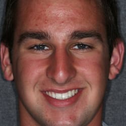 Castro Valley Dental Care - Michael K with crown on the minin implant replacing a space where he never had a tooth.