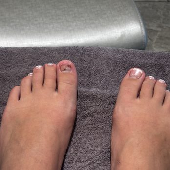 Sky Nail Spa and Tanning - What my toe looked like beforehand - Nail Salons Near Me - Auburn, Washington Sky Nail Spa and Tanning - What my toe looked like beforehand - Nail Salons Near Me - Auburn, Washington