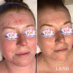 Acne Boot Camp