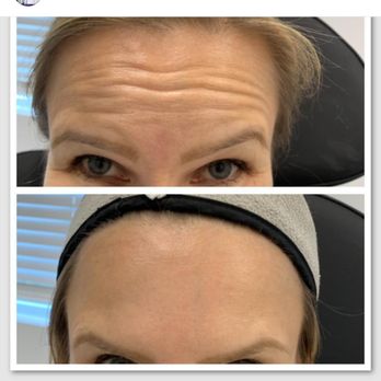 Radiance Medspa - Dysport in forehead to create glow and much smoother look. - Medical Spas Near Me - Weston, Florida Radiance Medspa - Dysport in forehead to create glow and much smoother look. - Medical Spas Near Me - Weston, Florida