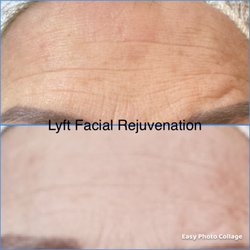 LYFT Facial Rejuvination - Liquid PDO Threads