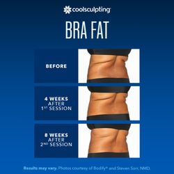 The Spa Boutique CoolSculpting of Trinity - Bra fat and back fat are easily removed with CoolSculpting. Call us for a free consultation.