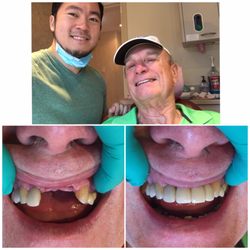 Morton Ranch Dental - 3 implants placed in the front to bring Mr. Davis' smile back! And ability to eat corn..