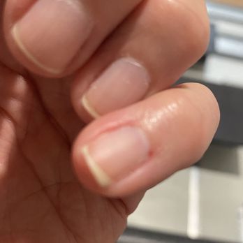 Baraboo Nail Spa - Bleeding from dry nipping - Nail Technicians Near Me - Baraboo, Wisconsin