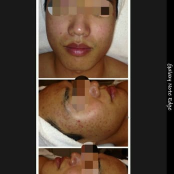 Joyce Beauty Studio - These are some before treatment photos of me. - Skin Care Near Me - San Diego, California Joyce Beauty Studio - These are some before treatment photos of me. - Skin Care Near Me - San Diego, California