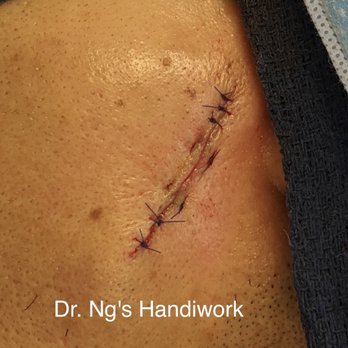 Wendy K Y Ng, MD - Dr. Ng's Stitches (she emailed this to me while my husband was still coming out of anesthesia) - Plastic Surgeons Near Me - Orange, California Wendy K Y Ng, MD - Dr. Ng's Stitches (she emailed this to me while my husband was still coming out of anesthesia) - Plastic Surgeons Near Me - Orange, California