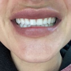 Wafelbakker Anderson Orthodontics - Before he put braces on me. My teeth were straight by no bite in my molars