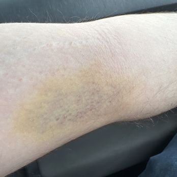 BioLife Plasma Services - Bruise (yellowing) - Blood & Plasma Donation Centers Near Me - Columbus, Ohio BioLife Plasma Services - Bruise (yellowing) - Blood & Plasma Donation Centers Near Me - Columbus, Ohio