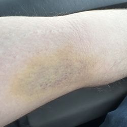 BioLife Plasma Services - Bruise (yellowing)