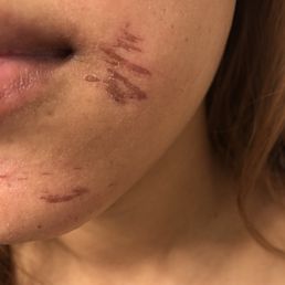 Burned my skin off with their wax. Burned my skin off with their wax.