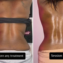 Back Treatment Results with 3 Sessions