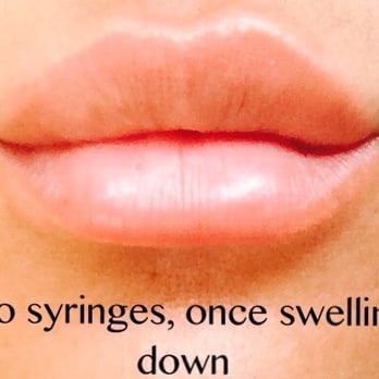 My Look - Lips after the 2 syringes of Juvéderm once the swelling went down. - Cosmetic Surgeons Near Me - Pasadena, California My Look - Lips after the 2 syringes of Juvéderm once the swelling went down. - Cosmetic Surgeons Near Me - Pasadena, California