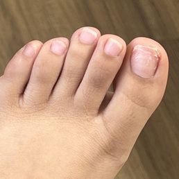 He cut my toe and tried to put glue He cut my toe and tried to put glue