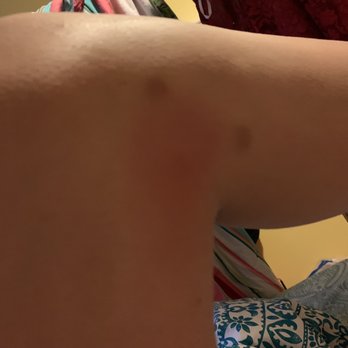 Meredith Communities - Bite 2/10 on my leg - Apartments Near Me - Norfolk, Virginia