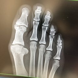 Ilan Bazak, DPM - My Right Foot with Benign Tumor Bone on Big Toe & Needle lodged in my second toe.