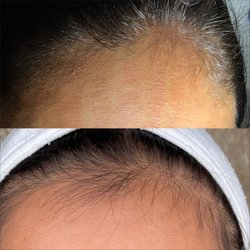 Catara Med Spa - Moved to Algonquin - Hair restoration.