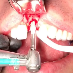 CeraRoot Zirconia Implants - Holistic Dentistry - This patient had an infection on the central incisor. On the same day, the tooth was extracted CeraRoot 21 implant was placed.