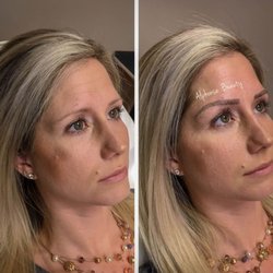 Alphonse Beauty Cosmetic Ink - Eyebrow Microblading Before & After.
