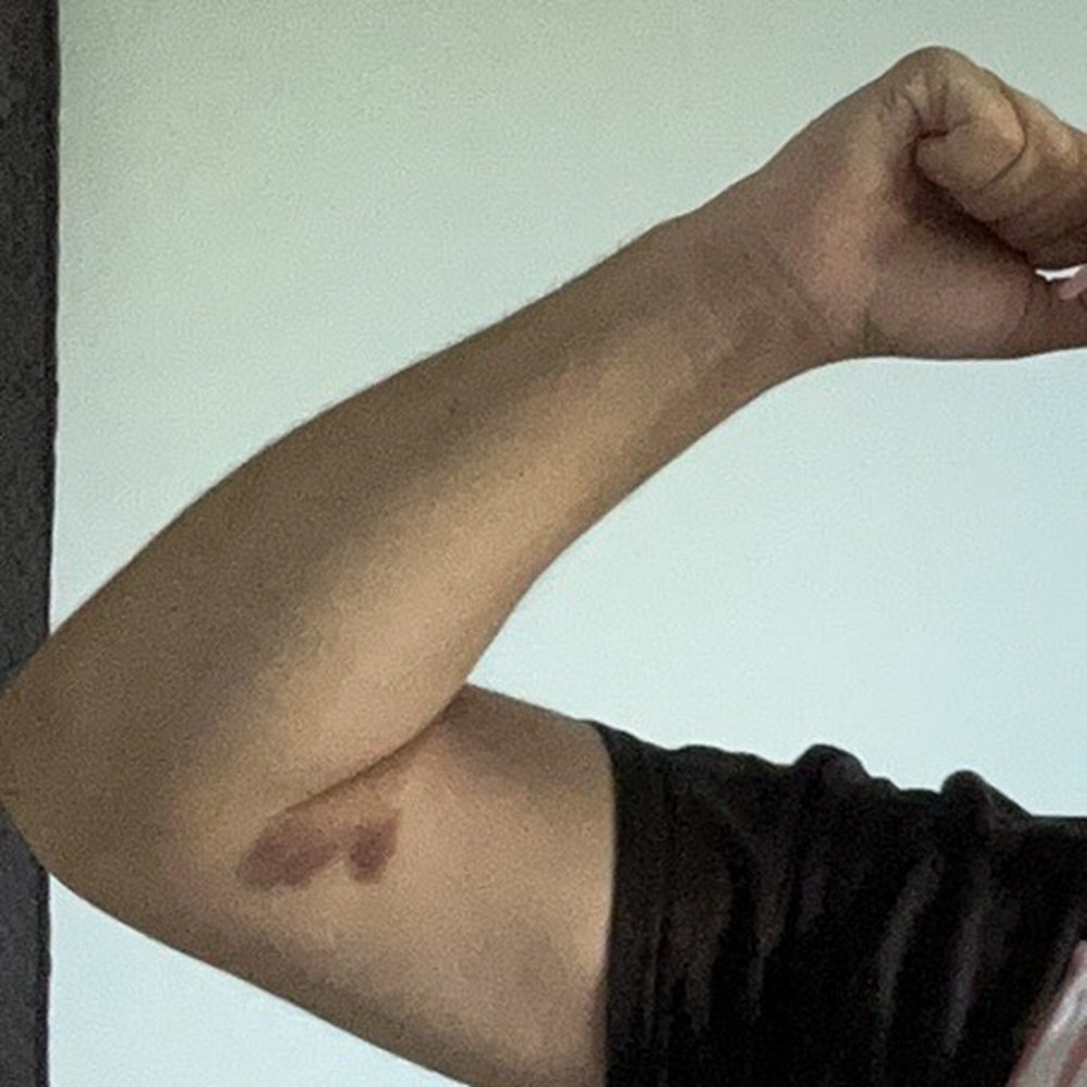 Bruise Bruise