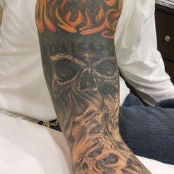 INK B GONE Tattoo Removal Denver - George BEFORE upper arm