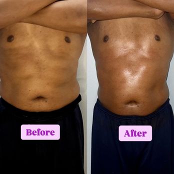 The Elaine Effect - Wood Therapy Before and After results after only 2 treatments - Body Contouring Near Me The Elaine Effect - Wood Therapy Before and After results after only 2 treatments - Body Contouring Near Me