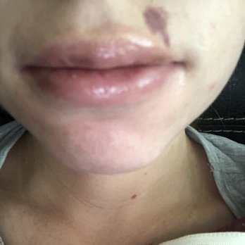 A.W. Brows & Lashes - Due to improper placement of the pen, I have bruises on my face which is uncalled for. - Permanent Makeup Near Me - Las Vegas, Nevada