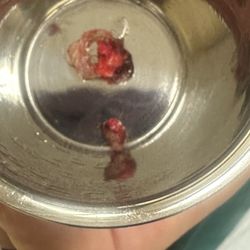 Rosario Skin Clinic - Cyst from behind ear