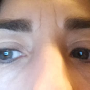 Sola Salon Studios - 3 months after initial procedure a plus 1 touchup 4weeks after. - Shared Office Spaces Near Me - Irvine, California Sola Salon Studios - 3 months after initial procedure a plus 1 touchup 4weeks after. - Shared Office Spaces Near Me - Irvine, California