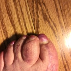 Feller Steve R DPM - Simple bunion removal and left big toe permanently curved over. Second toe left permanently swollen three times its size!