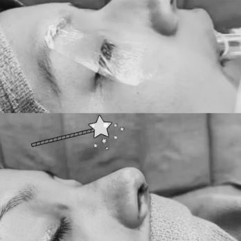 Michael Bublik, MD - Before & After - Ear Nose & Throat Near Me - Glendale, California