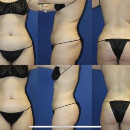 Before on top; after on bottom. Abdomen, back, hips VASERlipo Before on top; after on bottom. Abdomen, back, hips VASERlipo