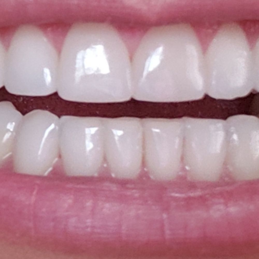 Glendora Dental - AFTER: Did bonding on my three front teeth. Wow I can't believe how great my teeth look. - Cosmetic Dentists Near Me - Glendora, California Glendora Dental - AFTER: Did bonding on my three front teeth. Wow I can't believe how great my teeth look. - Cosmetic Dentists Near Me - Glendora, California