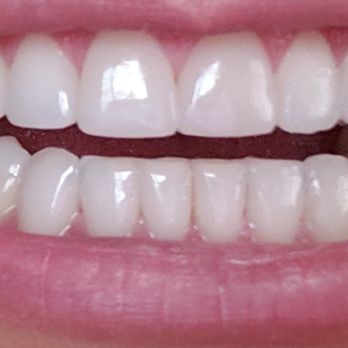 Glendora Dental - AFTER: Did bonding on my three front teeth.  Wow I can't believe how great my teeth look. - Cosmetic Dentists Near Me - Glendora, California