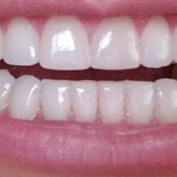 Glendora Dental - AFTER: Did bonding on my three front teeth. Wow I can't believe how great my teeth look.