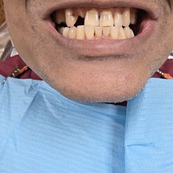 Beachside Dental Group - This is what they did to me and left me with . It's very disappointing to know how much they made me suffer. Beware of beachside dental. - General Dentistry Near Me - Huntington Beach, California Beachside Dental Group - This is what they did to me and left me with . It's very disappointing to know how much they made me suffer. Beware of beachside dental. - General Dentistry Near Me - Huntington Beach, California