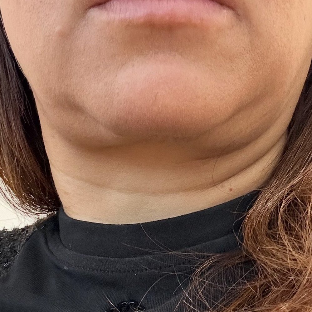 Batal Plastic Surgery - Final product. He's feeling proud of his work. - Plastic Surgeons Near Me - Santa Monica, California