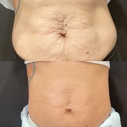 The Gleaux Lab Med Spa - 3 treatments later