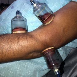 Certified Hijama-Cupping by Husain Abdul-Wahaab