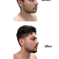 Unwinding Relaxation - Full Face contouring sessions after 4 sessions .
Sessions require 4-8 consistent sessions for results to be prominent.