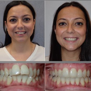 Smile Solutions Orthodontists - invisalignbrampton-beforeandafter - Orthodontists Near Me - Brampton, Ontario Smile Solutions Orthodontists - invisalignbrampton-beforeandafter - Orthodontists Near Me - Brampton, Ontario