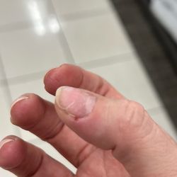 Solar Nails and Spa - Spilt thumb nail