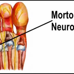 Adler Foot Care - Think you have Morton's Neuroms? Come in and see us, we can help.