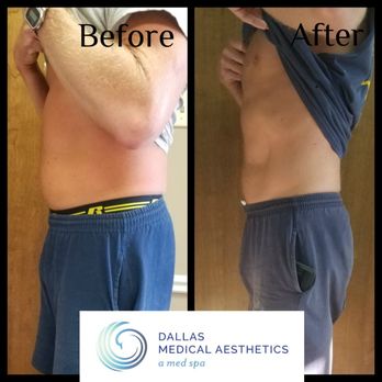 Dallas Medical Aesthetics - Office Patient - Body Contouring by InMode - Medical Spas Near Me - Dallas, Texas