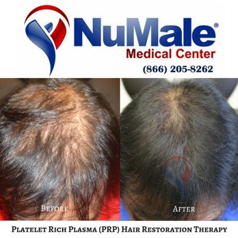 NuMale Medical Center - Platelet Rich Plasma (PRP) Hair Restoration Therapy for Men. NuMale Medical Center - Medical Centers Near Me - Ashwaubenon, Wisconsin NuMale Medical Center - Platelet Rich Plasma (PRP) Hair Restoration Therapy for Men. NuMale Medical Center - Medical Centers Near Me - Ashwaubenon, Wisconsin