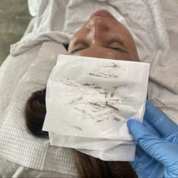 Chosen Esthetics - Dermaplaning facial
