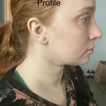 Vladimir Grigoryants, MD - 6 months post op - I think skin issues would be much better if he had recommended I wear a compression garment - he did not. - Cosmetic Surgeons Near Me - Glendale, California Vladimir Grigoryants, MD - 6 months post op - I think skin issues would be much better if he had recommended I wear a compression garment - he did not. - Cosmetic Surgeons Near Me - Glendale, California