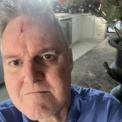 MD Now Urgent Care - Cracked on the floor getting up to go to the bathroom.