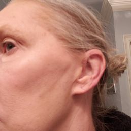 After second treatment